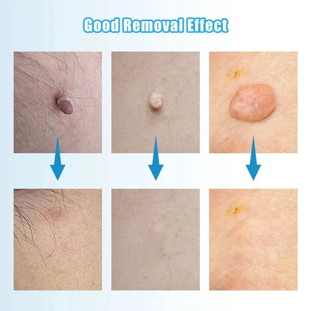 Manual Wart Removal Device At Home